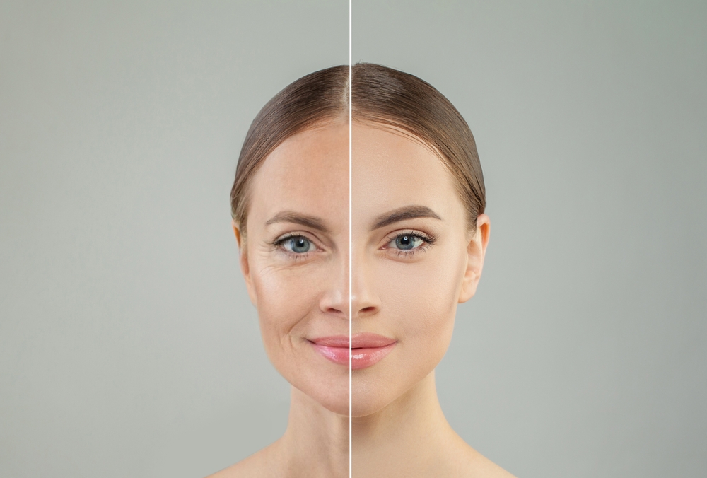 Botox vs. Fillers What’s the Difference and Which is Right for You - med spa new orleans - lolas med spa