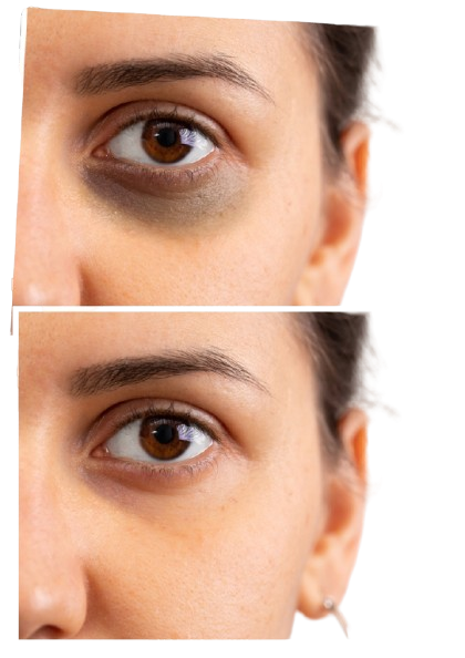 lolas med spa dark circle treatment in chalmette