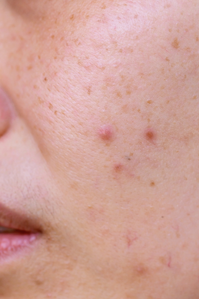 adult acne and uneven skin tone zo skin health lola med spa chalmette skin care